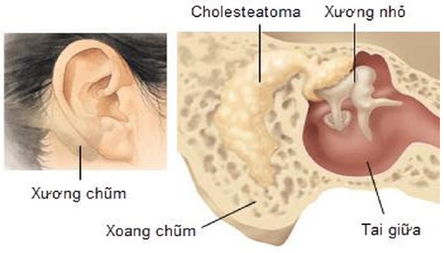 Bệnh Viêm tai xương chũm: Nguyên nhân, biến chứng và cách điều trị